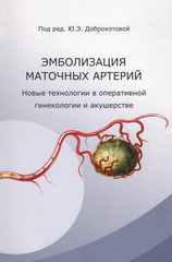 Эмболизация маточных артерий