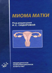 Миома матки