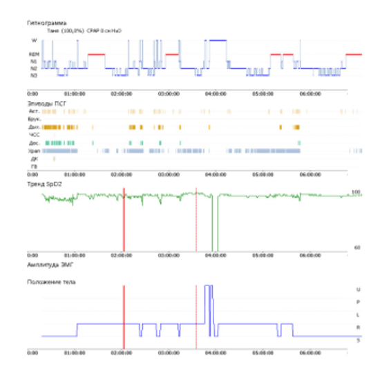 АМБУЛАТОРНАЯ ПСГ С ВИДЕОРЕГИСТРАЦИЕЙ (ТИП II)