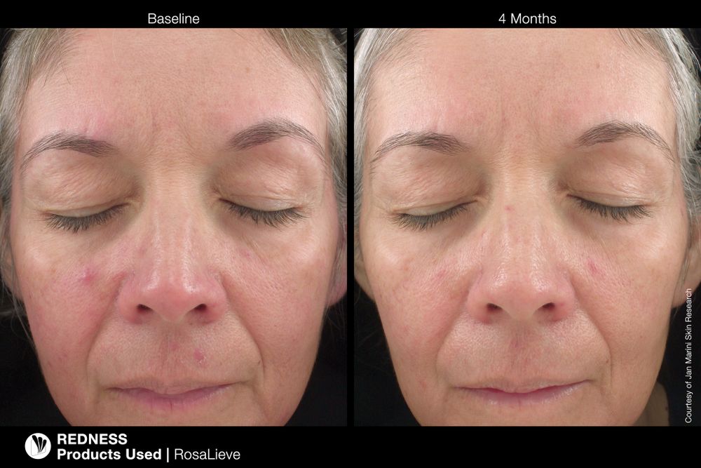 JAN MARINI ROSALIEVE Крем-акселератор для комплексного решения проблем розацеа