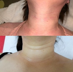 3G In-Volume Ampoule Eldermafill | Биореструктуризант