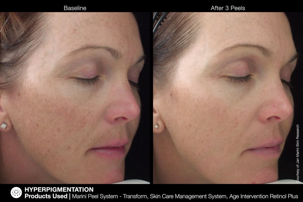 JAN MARINI AGE INTERVENTION RETINOL+ 0,5% Крем-акселератор с ретинолом 0,5% для борьбы с видимыми возрастными изменениями