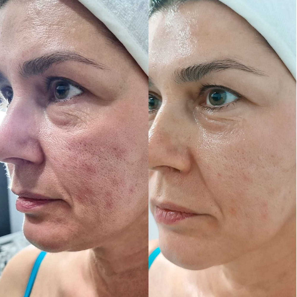 Rejusome | Сыворотка для омоложения кожи лица с экзосомами