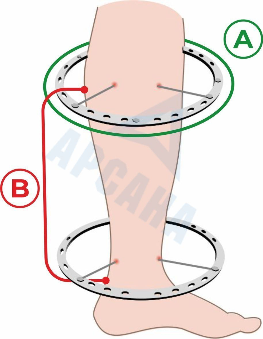 Чехол на аппарат внешней фиксации (Илизарова и др.) на голени (без полуколец). Легкий (хлопок + полиэстер), с открытой стопой./ ГО-5.