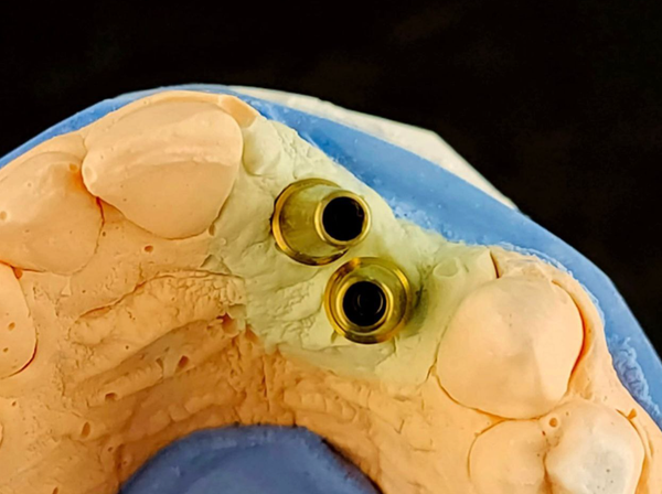 Отсутствие соосности между установленными имплантатами Отсутствие соосности между установленными имплантатами