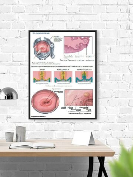 Обучающий медицинский плакат "Кольпоскопия" 600*900 мм