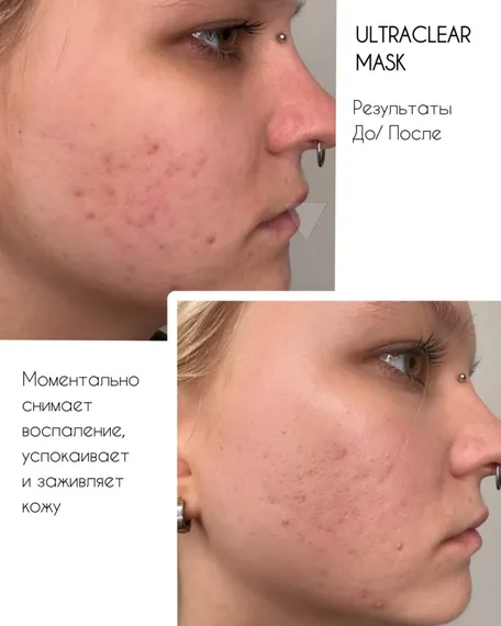 Маска для проблемной кожи