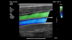 Аппарат УЗИ Philips Epiq 7