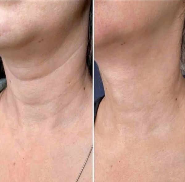 Лифтинг шеи: Как избавиться от «колец Венеры» и вернуть четкий контур Лифтинг шеи: Как избавиться от «колец Венеры» и вернуть четкий контур