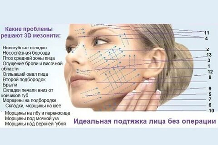 Армирование мезонитями по зонам лица