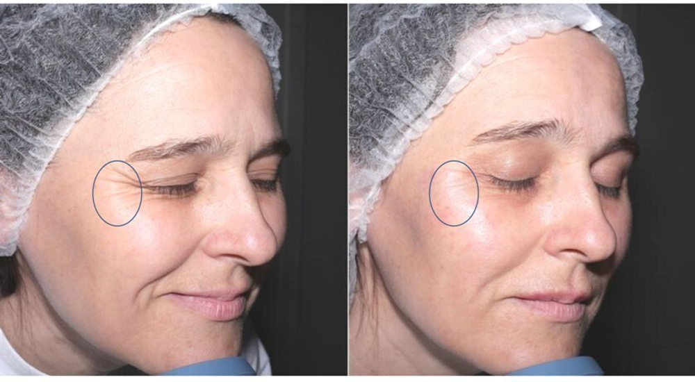 Cytocare S Line Revitacare | ГК 6мг/мл+CT50 | Биорепарант