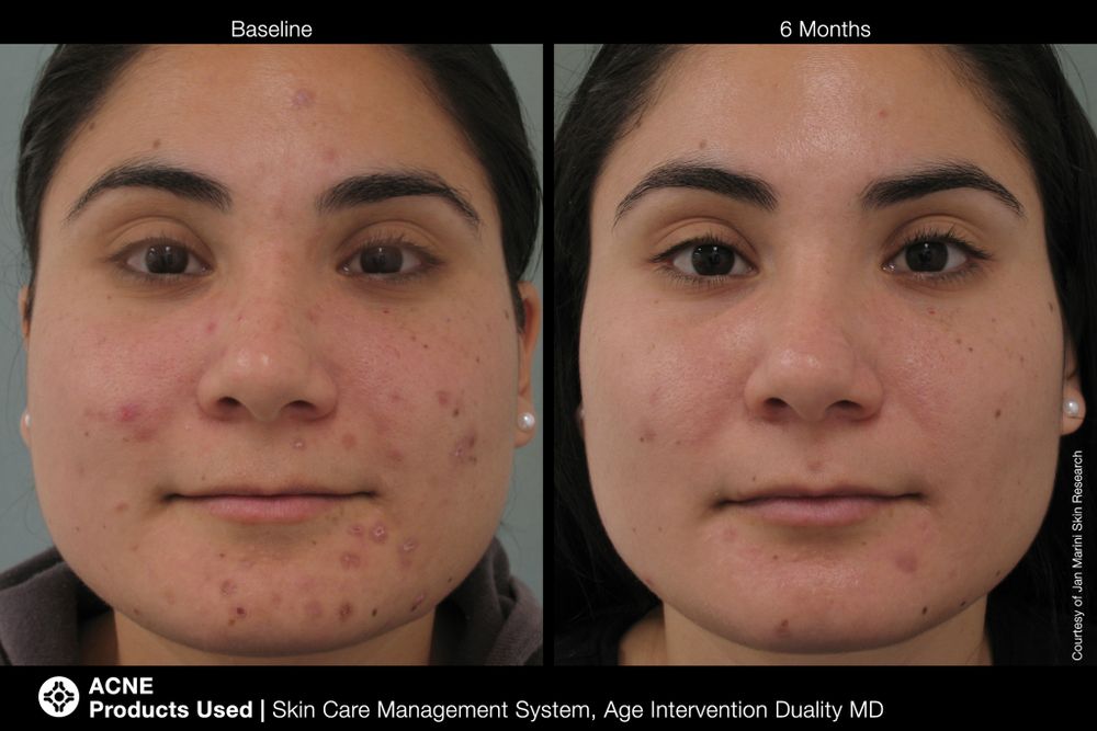 JAN MARINI AGE INTERVENTION DUALITY MD 0,9 % Крем-акселератор с ретинолом 0,9% для решения проблем возрастного акне