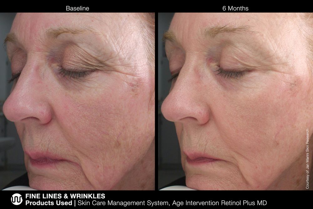 JAN MARINI AGE INTERVENTION RETINOL PLUS MD 1% Крем-акселератор с ретинолом 1% для борьбы с видимыми возрастными изменениями