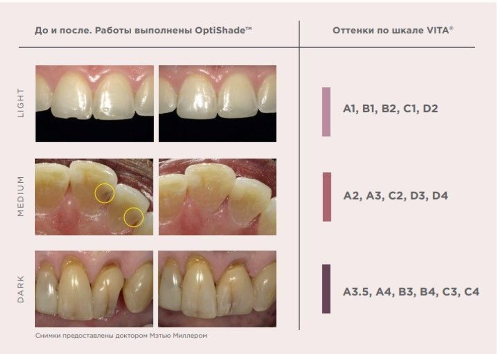 OptiShade / ОптиШейд (4 г) Light Kerr , пломбировочный материал ( пломба ), светоотверждаемый композит