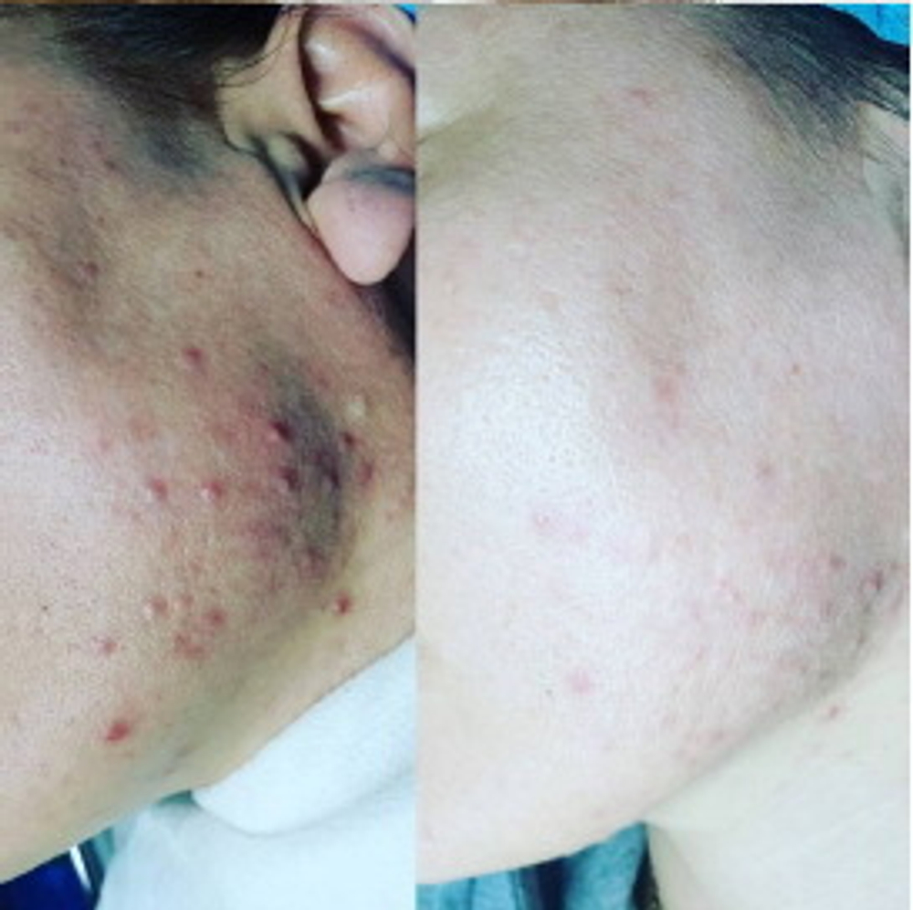 PDRN Rejuvenating Ampoule Eldermafill | Мощная регенерация