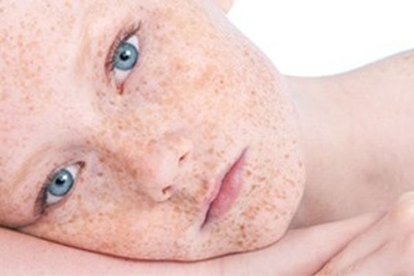 Гиперпигментация: как избавиться от пятен на коже? Комплексный подход