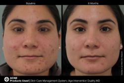 JAN MARINI AGE INTERVENTION DUALITY MD 0,9 % Крем-акселератор с ретинолом 0,9% для решения проблем возрастного акне