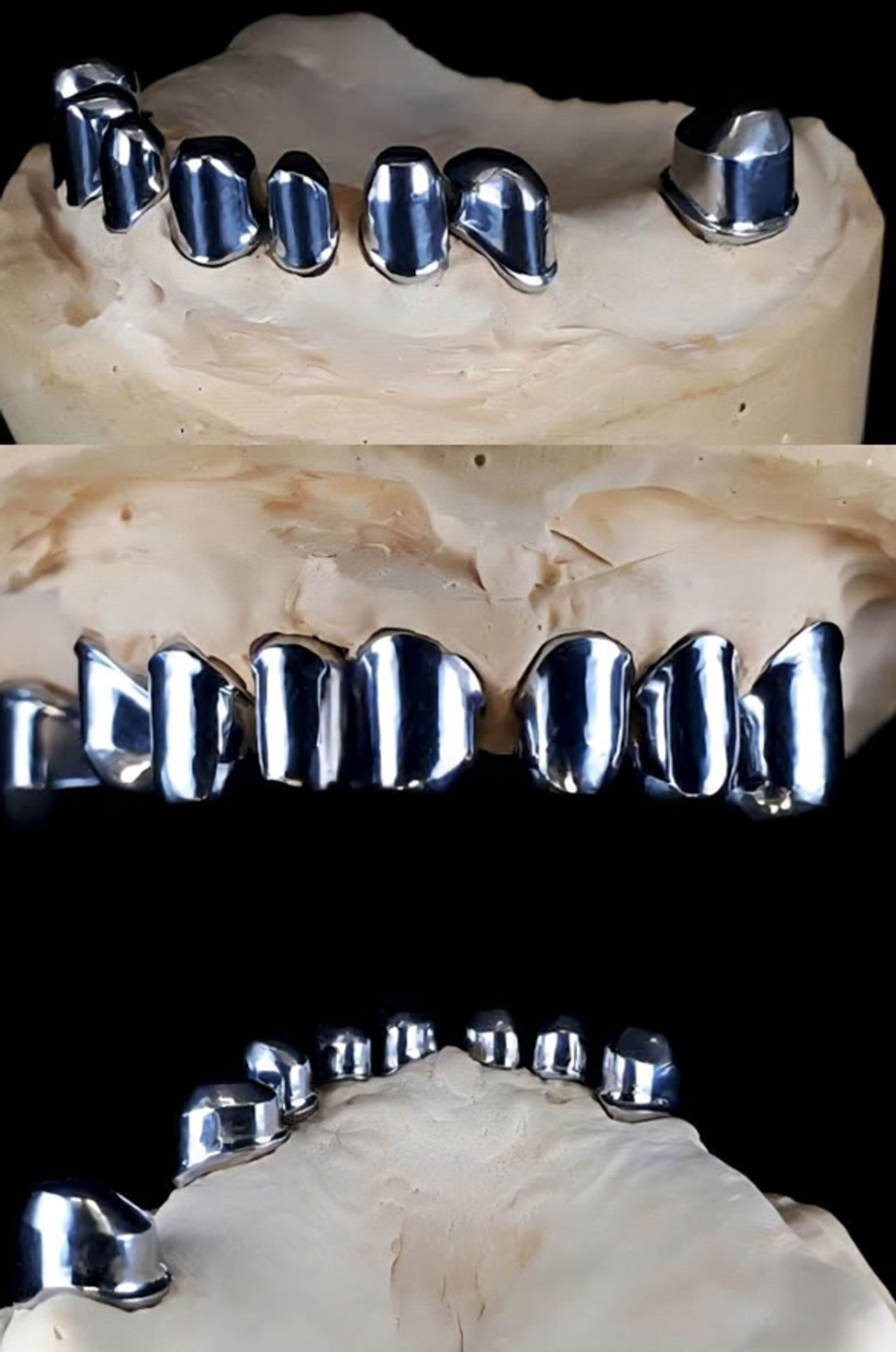 Замковые крепления в бюгельных протезах