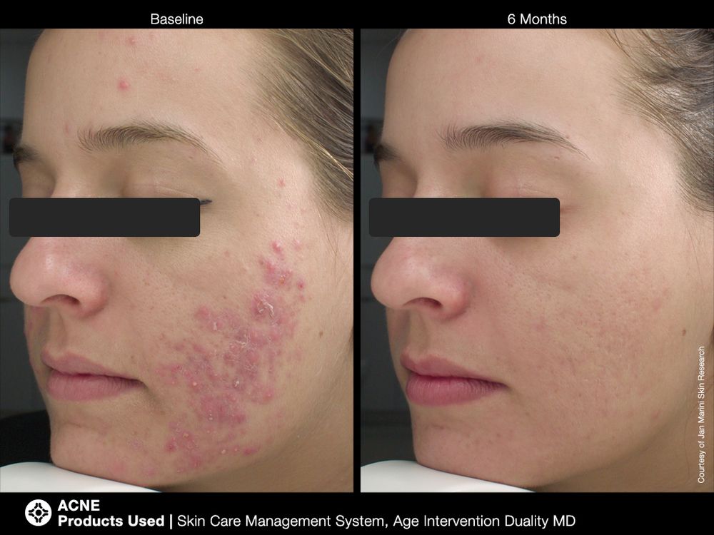 JAN MARINI AGE INTERVENTION DUALITY MD 0,9 % Крем-акселератор с ретинолом 0,9% для решения проблем возрастного акне