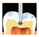 Бор твердосплавный Midwest - 123 FG 6