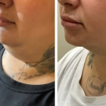 Lipo Idealist Skin Safe