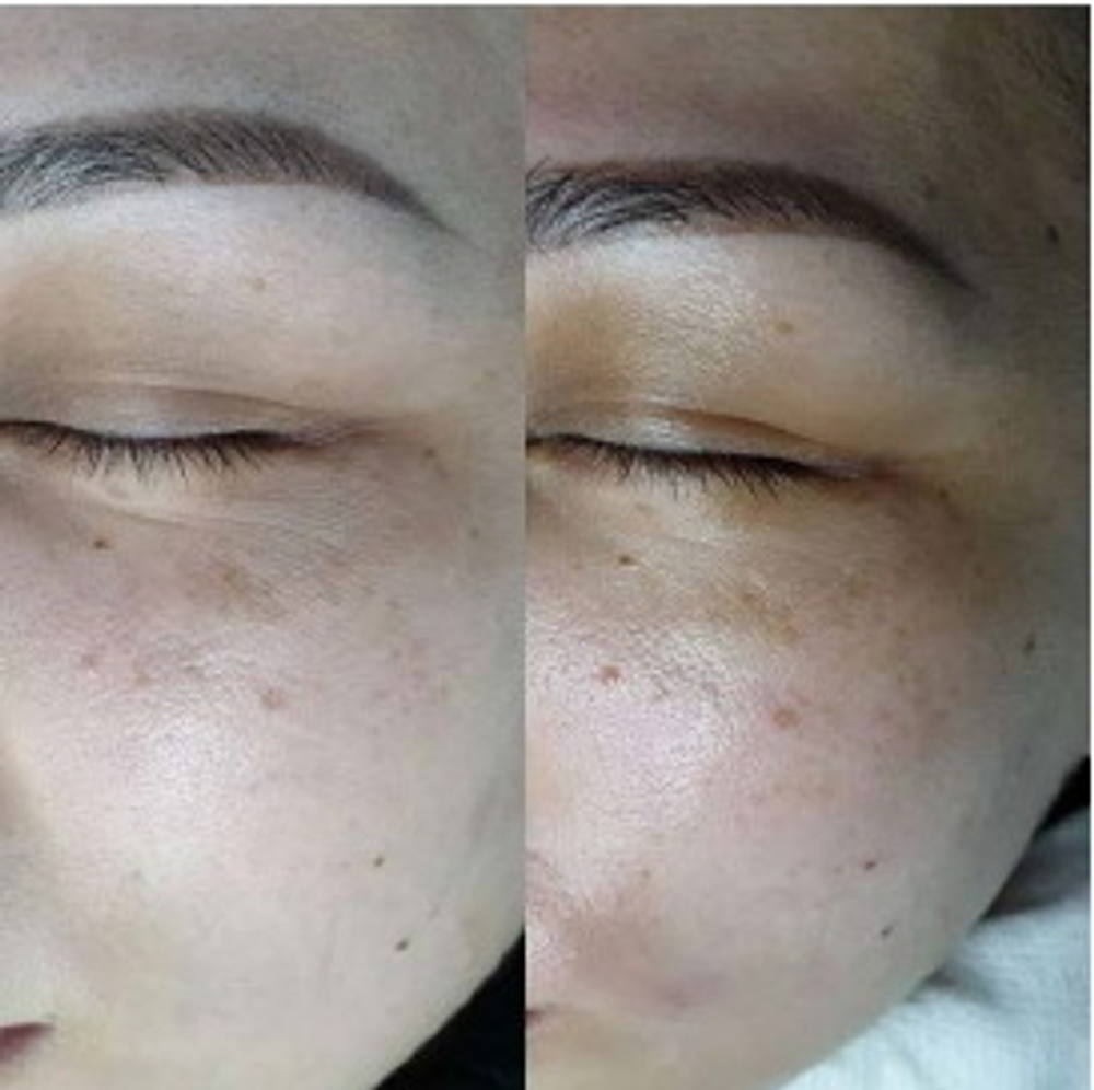 PDRN Rejuvenating Ampoule Eldermafill | Мощная регенерация