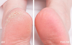 Средство Би Натурал для удаления натоптышей Апельсин 30мл