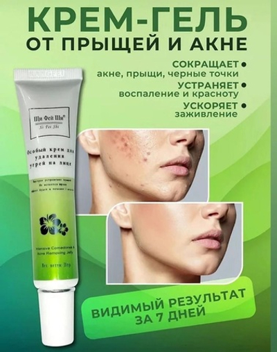 Крем-гель от прыщей и акне