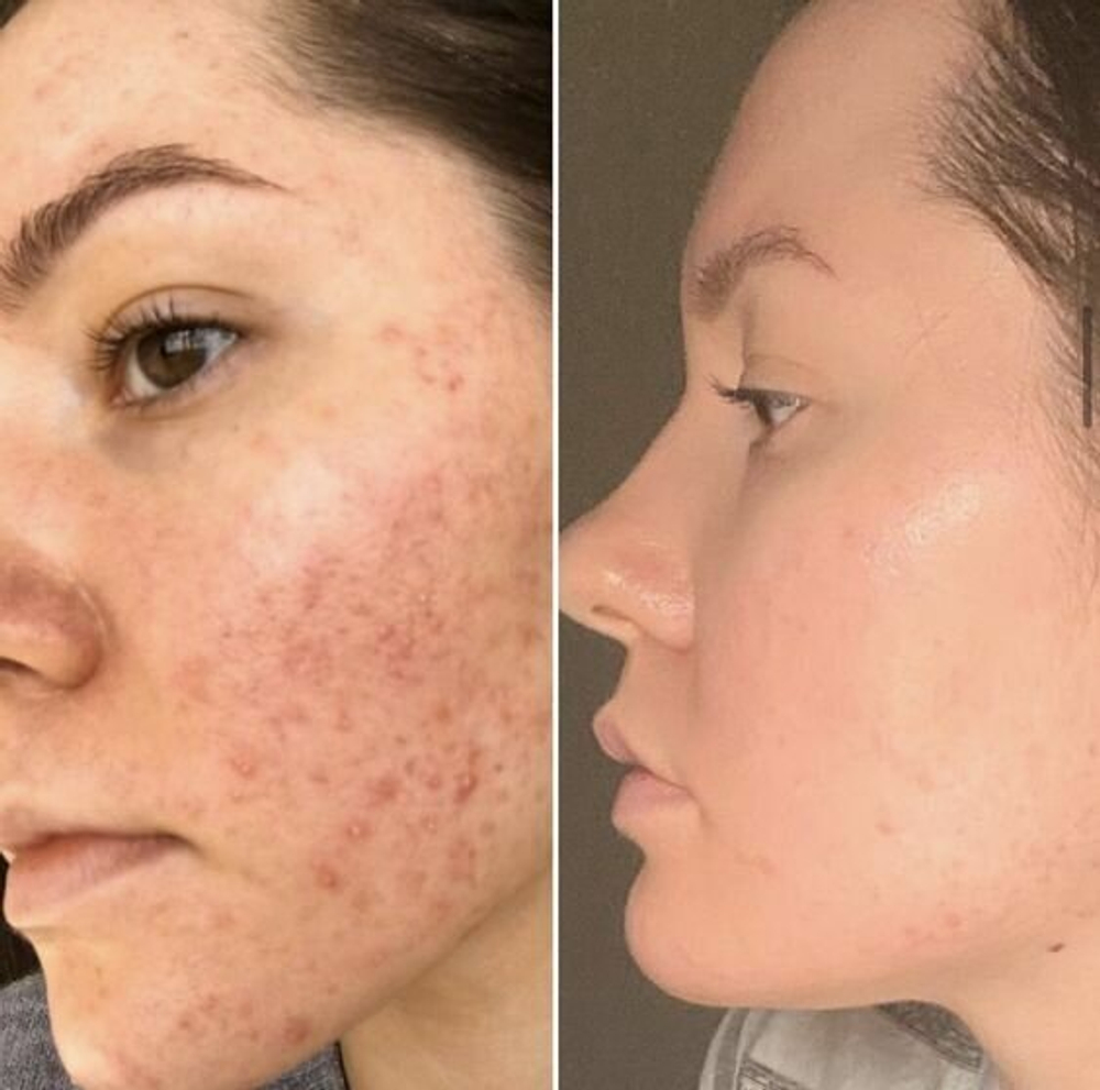 Кислотная сыворотка для проблемной кожи SOME BY MI AHA-BHA-PHA 30 Days Miracle Serum 50 мл.