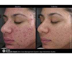 JAN MARINI AGE INTERVENTION DUALITY 0,6% Крем-акселератор с ретинолом 0,6% для решения проблем возрастного акне