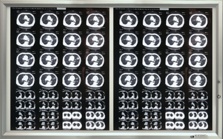 Негатоскоп на 2 снимка медицинский светодиодный