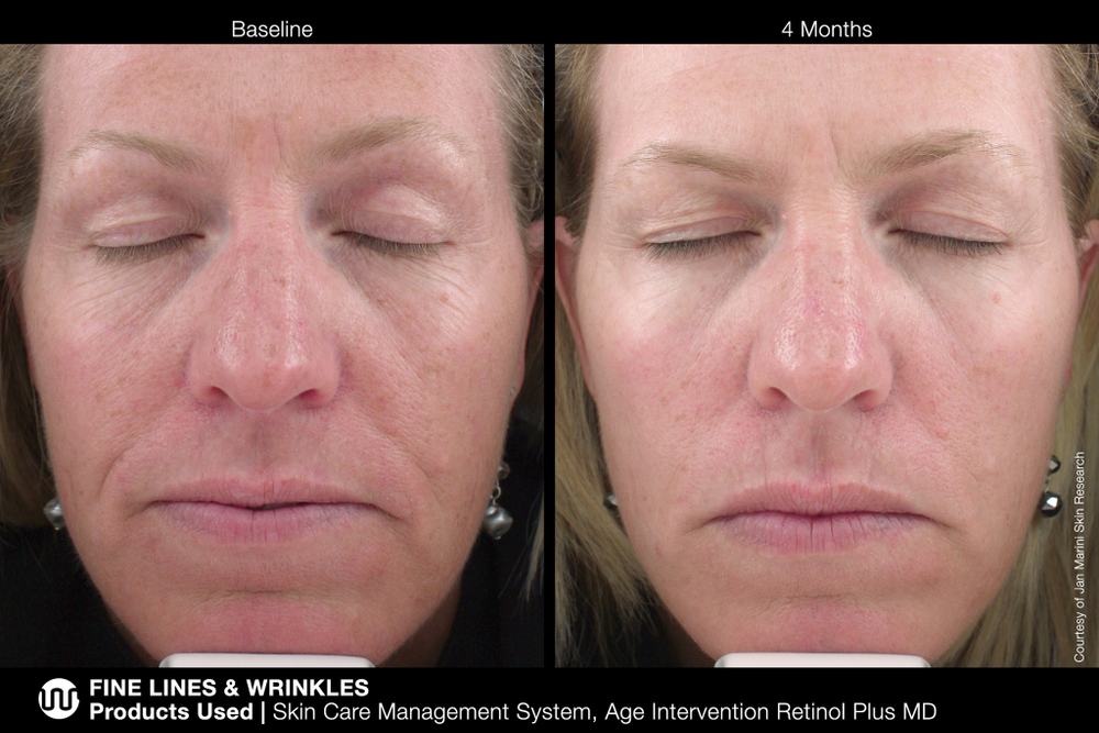 JAN MARINI AGE INTERVENTION RETINOL PLUS MD 1% Крем-акселератор с ретинолом 1% для борьбы с видимыми возрастными изменениями