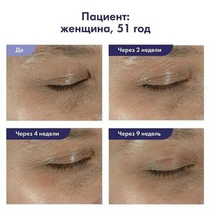 Крем для восстановления эластичности кожи вокруг глаз ELASTIderm Eye Cream, Obagi Medical, 15 гр