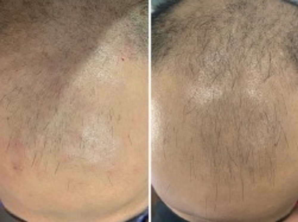 Hair Forest Ampoule Eldermafill | Восстановление волос