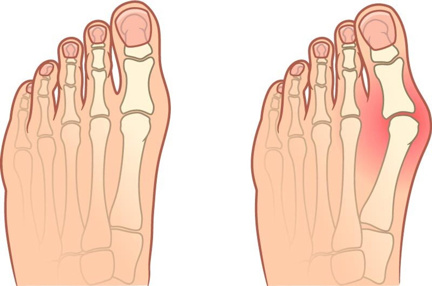 Вальгусная деформация стопы - Hallux Valgus
