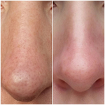 Салфетки для удаления чёрных точек Ciracle Blackhead Off Cotton Mask, 20 шт по 5мл.