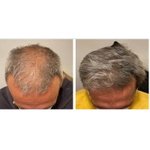 ASCE+ HRLV ExoCoBio | Лиофилизированный порошок экзосом для восстановления кожи головы и волос