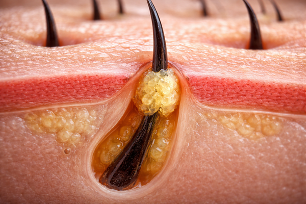 Микрокомедондар: акненің «жұмыртқасы» және терапияның жасырын нысанасы