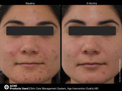 JAN MARINI AGE INTERVENTION DUALITY MD 0,9 % Крем-акселератор с ретинолом 0,9% для решения проблем возрастного акне