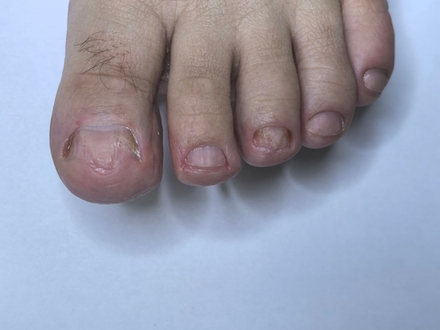 Обработка 10ед легка степень (возможна с поражением частично)