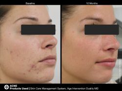 JAN MARINI SKIN CARE MANAGEMENT SYSTEM (NORMAL-COMBO) SPF33