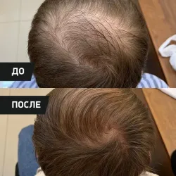 PERFOTESORO кислородная сыворотка для активного роста волос