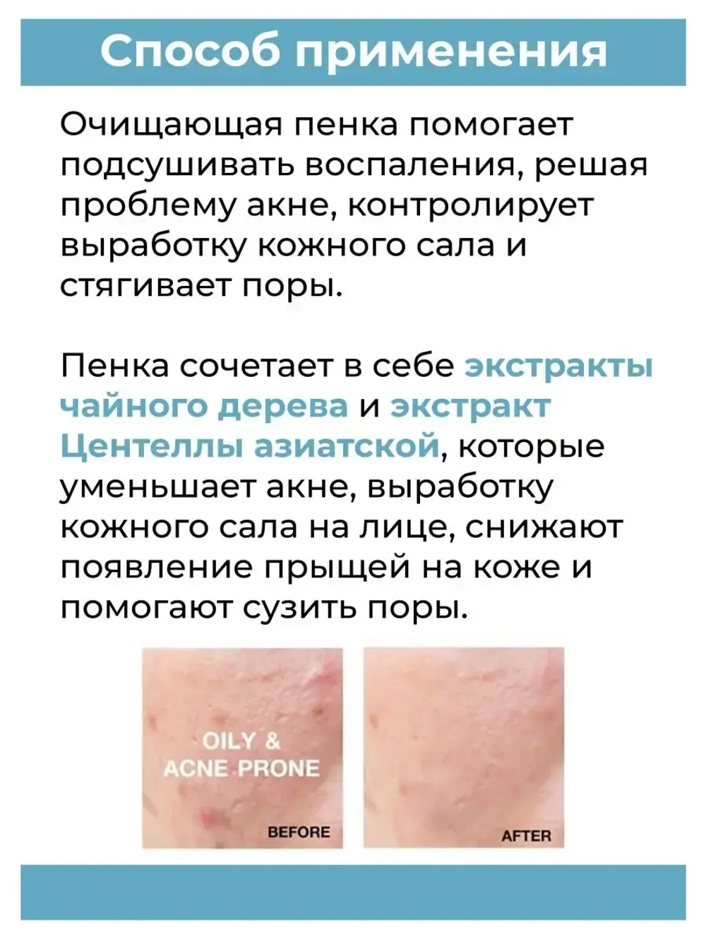 Умывалка для лица антижир от акнэ 120мл.