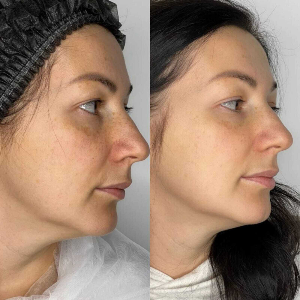 Rejusome | Сыворотка для омоложения кожи лица с экзосомами