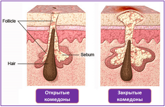 Закрытые комедоны: инструкция по ликвидации