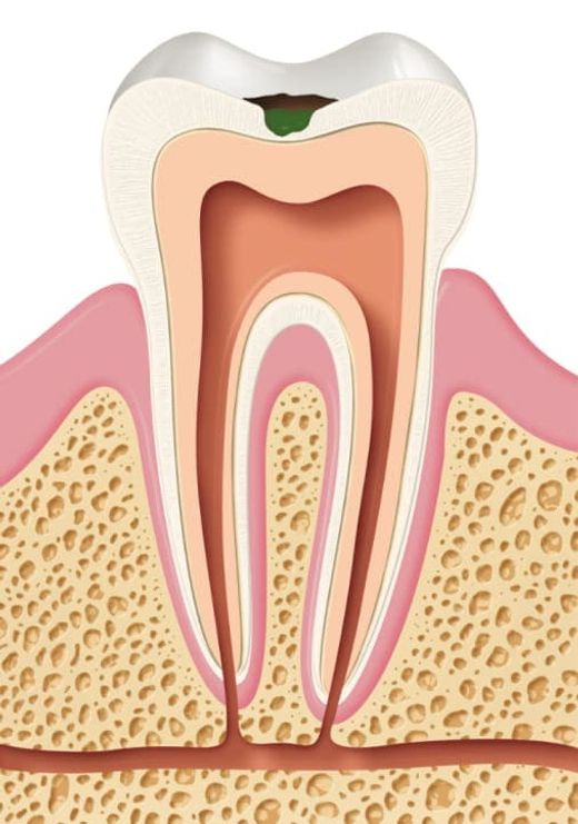 Лечение кариеса