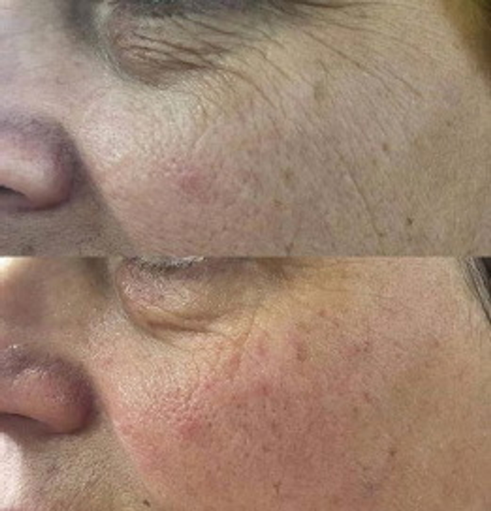 PDRN Booster Eldermafill | Усилитель мезотерапии