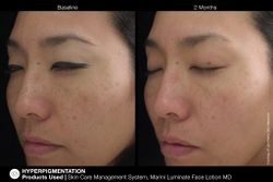 JAN MARINI LUMINATE FACE LOTION MD, 0,75% Крем-акселератор с ретинолом 0,75% для борьбы с пигментацией