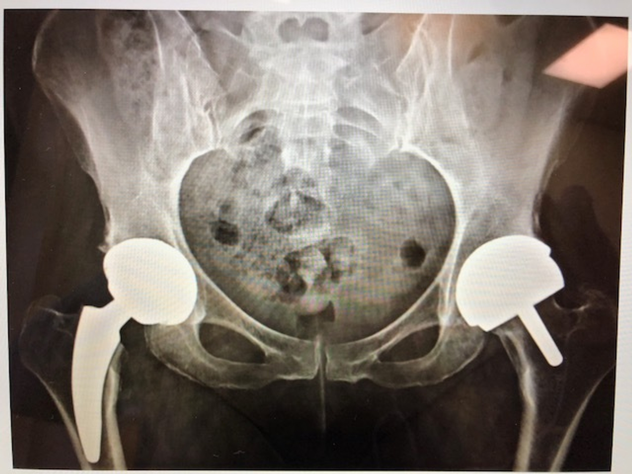 Тазобедренный сустав