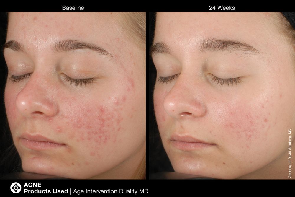 JAN MARINI AGE INTERVENTION DUALITY MD 0,9 % Крем-акселератор с ретинолом 0,9% для решения проблем возрастного акне